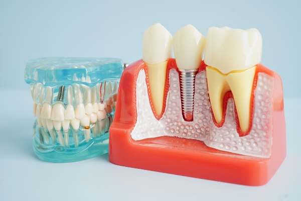 What Exactly Are Dental Implants?